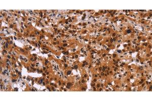 Immunohistochemistry of paraffin-embedded Human thyroid cancer using GPR124 Polyclonal Antibody at dilution of 1:40 (GPR124 anticorps)