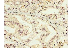 IHC image of ABIN7166949 diluted at 1:200 and staining in paraffin-embedded human prostate cancer performed on a Leica BondTM system. (GDI1 anticorps  (AA 35-170))