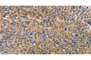 Immunohistochemistry of paraffin-embedded Human liver cancer tissue using ANXA10 Polyclonal Antibody at dilution 1:35 (Annexin a10 anticorps)