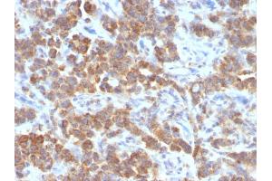 Formalin-fixed, paraffin-embedded human Parathyroid Mass stained with TNFS15 / VEGI Monoclonal Antibody (VEGI /1283).