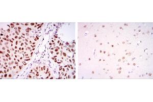 Immunohistochemical analysis of paraffin-embedded lung cancer tissues (left) and brain tissues (right) using PSIP1 mouse mAb with DAB staining.