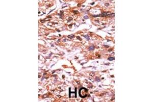 Formalin-fixed and paraffin-embedded human cancer tissue reacted with the primary antibody, which was peroxidase-conjugated to the secondary antibody, followed by AEC staining.