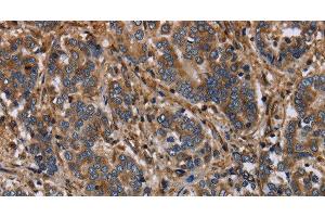Immunohistochemistry of paraffin-embedded Human liver cancer using FLNA Polyclonal Antibody at dilution of 1:40