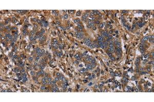 Immunohistochemistry of paraffin-embedded Human liver cancer using FLNA Polyclonal Antibody at dilution of 1:40 (Filamin A anticorps)