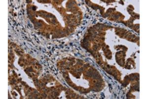 The image on the left is immunohistochemistry of paraffin-embedded Human gastic cancer tissue using ABIN7191351(MAGEB3 Antibody) at dilution 1/20, on the right is treated with synthetic peptide. (MAGEB3 anticorps)
