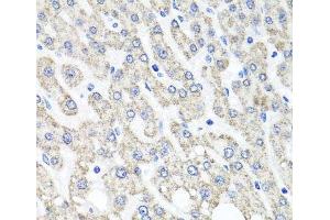 Immunohistochemistry of paraffin-embedded Human liver damage using OTC Polyclonal Antibody at dilution of 1:100 (40x lens). (OTC anticorps)
