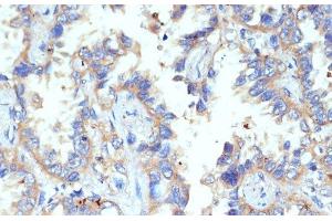 Immunohistochemistry of paraffin-embedded Human lung cancer using CD47 Polyclonal Antibody at dilution of 1:200 (40x lens). (CD47 anticorps)