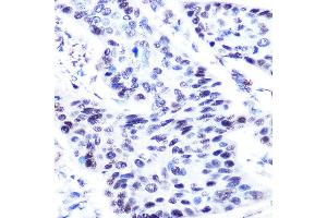 Immunohistochemistry of paraffin-embedded human esophageal cancer using p63 antibody (ABIN3023011, ABIN3023012, ABIN3023013, ABIN1513632 and ABIN6219346) at dilution of 1:50 (40x lens). (p63 anticorps  (AA 421-680))