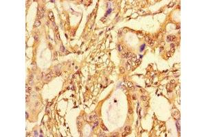 Immunohistochemistry of paraffin-embedded human pancreatic cancer using ABIN7172704 at dilution of 1:100 (SUPT3H/SPT3 anticorps  (AA 1-328))