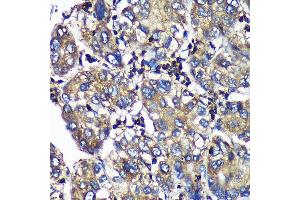 Immunohistochemistry of paraffin-embedded Human liver cancer using SENP1 Rabbit pAb (ABIN6132646, ABIN6147534, ABIN6147536 and ABIN6216945) at dilution of 1:100 (40x lens). (SENP1 anticorps  (AA 220-420))