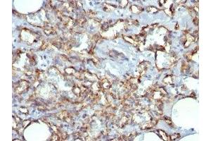Formalin-fixed, paraffin-embedded human Angiosarcoma stained with CD31 antibody (JC/70A) (CD31 anticorps)