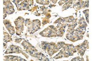 ABIN6262447 and ABIN6266925 at 1/100 staining Human pancreatic cancer and adjacent nomal tissues by IHC-P.