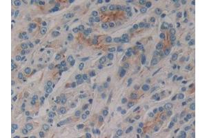 DAB staining on IHC-P; Samples: Human Prostate cancer Tissue (CD1e anticorps  (AA 39-276))