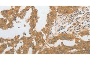 Immunohistochemistry of paraffin-embedded Human ovarian cancer tissue using GRIN2C Polyclonal Antibody at dilution 1:80 (GRIN2C anticorps)