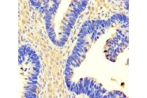 Immunohistochemistry of paraffin-embedded human ovarian cancer using ABIN7174304 at dilution of 1:100 (USP3 anticorps  (C-Term))