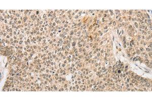 Immunohistochemistry of paraffin-embedded Human lung cancer tissue using RPL26L1 Polyclonal Antibody at dilution 1:30 (RPL26L1 anticorps)