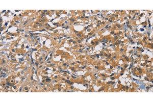 Immunohistochemistry of paraffin-embedded Human thyroid cancer tissue using PIKFYVE Polyclonal Antibody at dilution 1:50 (PIKFYVE anticorps)
