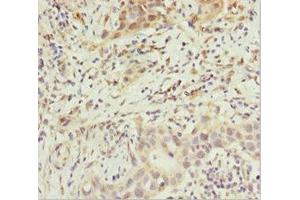 Immunohistochemistry of paraffin-embedded human bladder cancer using ABIN7144897 at dilution of 1:100 (ABCB8 anticorps  (AA 486-735))