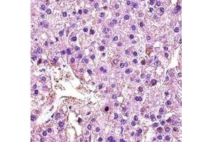 LDHA antibody immunohistochemistry analysis in formalin fixed and paraffin embedded human hepatocarcinoma