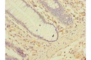 Immunohistochemistry of paraffin-embedded human colon cancer using ABIN7158150 at dilution of 1:100 (LRRC2 anticorps  (AA 1-371))