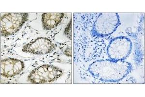 Immunohistochemistry analysis of paraffin-embedded human colon carcinoma, using ATR (Phospho-Ser428) Antibody.