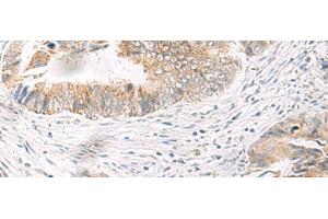 Immunohistochemistry of paraffin-embedded Human colorectal cancer tissue using IDUA Polyclonal Antibody at dilution of 1:35(x200)
