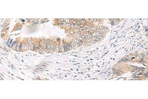 Immunohistochemistry of paraffin-embedded Human colorectal cancer tissue using IDUA Polyclonal Antibody at dilution of 1:35(x200) (IDUA anticorps)