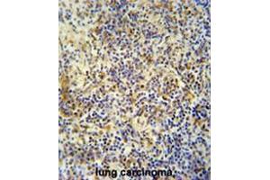 KRI1 antibody (N-term) immunohistochemistry analysis in formalin fixed and paraffin embedded human lung carcinoma followed by peroxidase conjugation of the secondary antibody and DAB staining. (KRI1 anticorps  (N-Term))