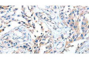 Immunohistochemistry of paraffin-embedded Human esophagus cancer using AOX1 Polyclonal Antibody at dilution of 1:65 (AOX1 anticorps)