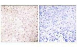Immunohistochemical analysis of paraffin-embedded human breast carcinoma tissue using P300/CBP antibody. (EP3/CREBBP anticorps)