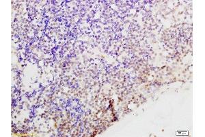 Formalin-fixed and paraffin embedded human endometrium carcinoma tissue labeled with Anti-Cyclin G Polyclonal Antibody, Unconjugated  at 1:200 followed by conjugation to the secondary antibody and DAB stainin