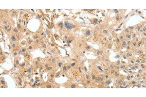 Immunohistochemistry of paraffin-embedded Human breast cancer tissue using COL4A1 Polyclonal Antibody at dilution 1:30
