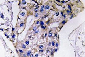 Immunohistochemistry (IHC) analyzes of IL-5 antibody in paraffin-embedded human breast carcinoma tissue. (IL-5 anticorps)
