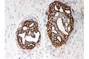 Anti- PKM2 Picoband antibody, IHC(P) IHC(P): Human Mammary Cancer Tissue (PKM anticorps  (N-Term))