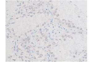 ABIN6267554 at 1/200 staining Human lung cancer tissue sections by IHC-P.