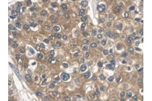 DAB staining on IHC-P; Samples: Human Prostate cancer Tissue (ALDOA anticorps  (AA 18-273))