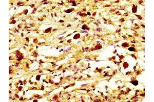 IHC image of ABIN7160588 diluted at 1:800 and staining in paraffin-embedded human melanoma performed on a Leica BondTM system. (MYH7 anticorps  (AA 1802-1915))