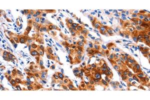 Immunohistochemistry of paraffin-embedded Human lung cancer tissue using SEPT4 Polyclonal Antibody at dilution 1:50 (Septin 4 anticorps)