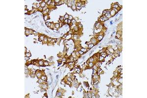 Immunohistochemistry of paraffin-embedded human lung cancer using Septin 4 antibody (ABIN6128476, ABIN6147554, ABIN6147555 and ABIN6214410) at dilution of 1:100 (40x lens).