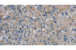 Immunohistochemistry of paraffin-embedded Human liver cancer tissue using PGLYRP1 Polyclonal Antibody at dilution 1:40 (PGLYRP1 anticorps)