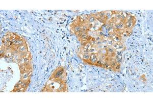 Immunohistochemistry of paraffin-embedded Human cervical cancer using ANXA3 Polyclonal Antibody at dilution of 1:35 (Annexin A3 anticorps)