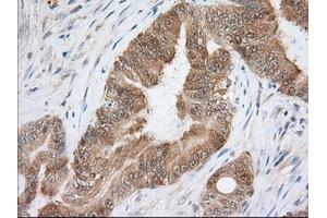 Immunohistochemical staining of paraffin-embedded Human liver tissue using anti-ACAT2 mouse monoclonal antibody. (ACAT2 anticorps)