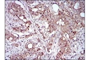 Immunohistochemical analysis of paraffin-embedded human cervical cancer tissues using GAB2 mouse mAb with DAB staining. (GAB2 anticorps  (AA 332-476))