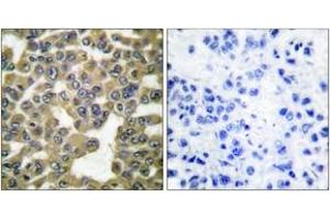 Immunohistochemistry analysis of paraffin-embedded human breast carcinoma tissue, using MMP-13 Antibody.