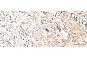 Immunohistochemistry of paraffin-embedded Human prost ate cancer tissue using NREP Polyclonal Antibody at dilution of 1:35(x200) (NREP anticorps)