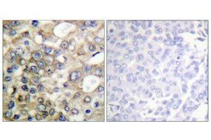 Immunohistochemistry (IHC) image for anti-Mucin 1 (MUC1) (pTyr1229) antibody (ABIN1847432) (MUC1 anticorps  (pTyr1229))
