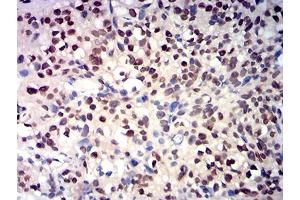 Immunohistochemical analysis of paraffin-embedded bladder cancer tissues using RBBP7 mouse mAb with DAB staining.