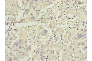 Immunohistochemistry of paraffin-embedded human liver cancer using ABIN7149016 at dilution of 1:100 (CDO1 anticorps  (AA 1-200))