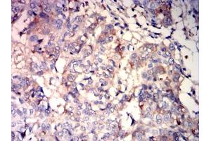 Immunohistochemical analysis of paraffin-embedded bladder cancer tissues using ALB mouse mAb with DAB staining.