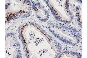 Immunohistochemical staining of paraffin-embedded Adenocarcinoma of Human colon tissue using anti-FGFR2 mouse monoclonal antibody. (FGFR2 anticorps)